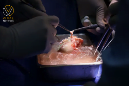 العملية الأولى لزراعة كلية من خنزير إلى إنسان