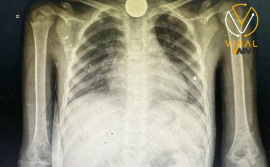 طبيب عماني يروي ما يأكله الأطفال في غزة بسبب الجوع