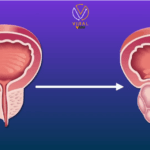 الكشف المبكر عن سرطان البروستاتا عبر اللعاب