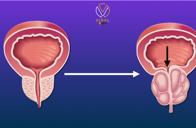 الكشف المبكر عن سرطان البروستاتا عبر اللعاب
