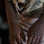 بايدن يعلن عن مساهمة الولايات المتحدة بمليون جرعة من لقاح جدري القرود لأفريقيا