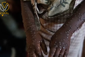 بايدن يعلن عن مساهمة الولايات المتحدة بمليون جرعة من لقاح جدري القرود لأفريقيا