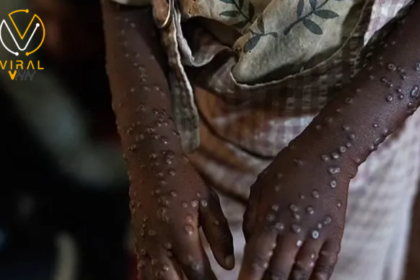 بايدن يعلن عن مساهمة الولايات المتحدة بمليون جرعة من لقاح جدري القرود لأفريقيا