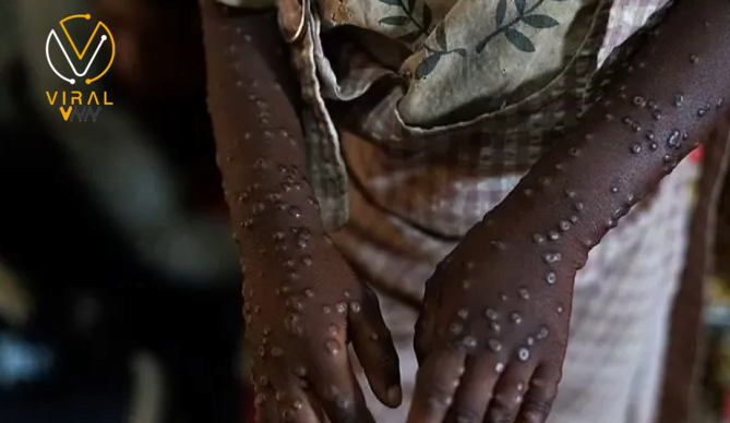 بايدن يعلن عن مساهمة الولايات المتحدة بمليون جرعة من لقاح جدري القرود لأفريقيا