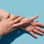 بريطانيا تعلن عن أول حالة لجدري القرود خارج أفريقيا