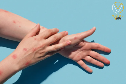 بريطانيا تعلن عن أول حالة لجدري القرود خارج أفريقيا