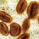 كندا تسجل أول حالة مصابة بسلالة جديدة من جدري القردة