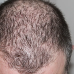 نظام غذائي معروف لإنقاص الوزن يرفع خطر تساقط الشعر