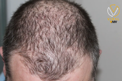 نظام غذائي معروف لإنقاص الوزن يرفع خطر تساقط الشعر