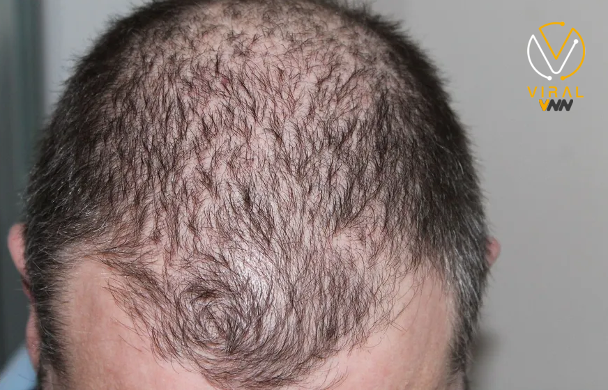 نظام غذائي معروف لإنقاص الوزن يرفع خطر تساقط الشعر