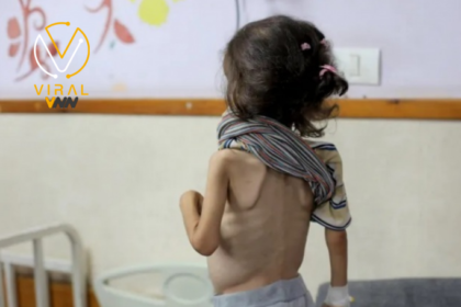 أونروا تحذر من خطورة سوء التغذية على الأطفال في غزة